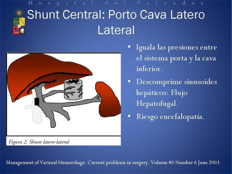 Diapositiva 25 de Hipertensión Portal:Alternativas Terapeuticas