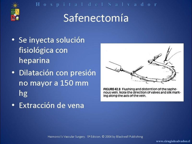 Diapositiva 10 de Safenectomía