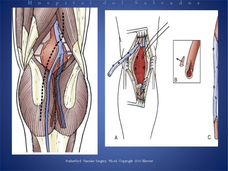 Diapositiva 25 de Aneurismas Arteriales EEII