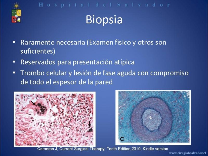Diapositiva 24 de Tromboangeitis Obliterante(Enfermedad de Buerger)
