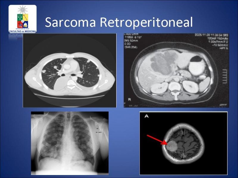 Diapositiva 12 de Sarcoma Retroperitoneal
