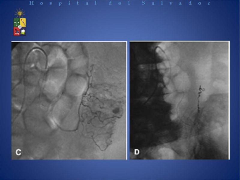 Diapositiva 13 de Cirugía endovascular en HDB