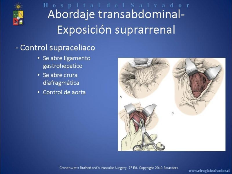 Diapositiva 18 de Abordaje de Aorta abdominal