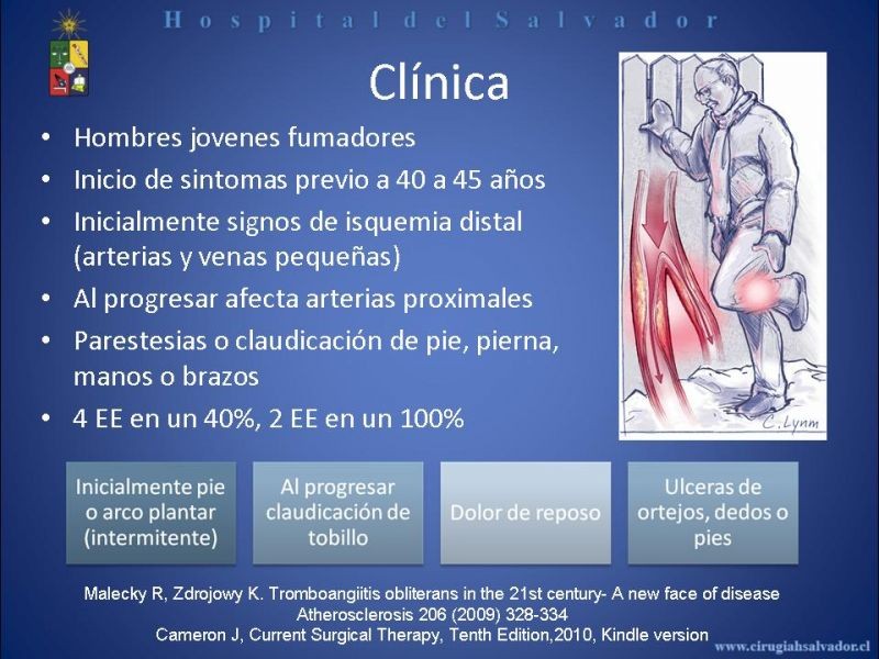 Diapositiva 12 de Tromboangeitis Obliterante(Enfermedad de Buerger)
