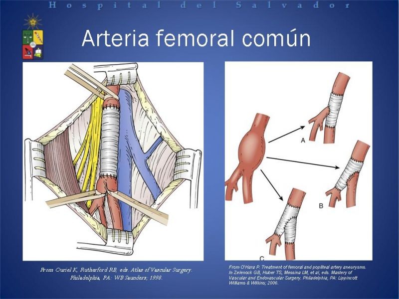 Diapositiva 13 de Aneurismas Arteriales EEII