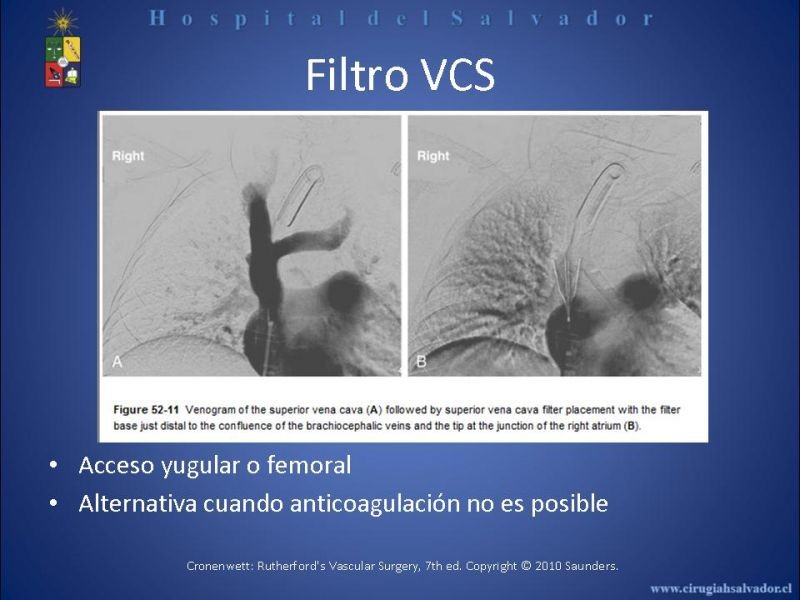 Diapositiva 23 de Filtro Vena Cava