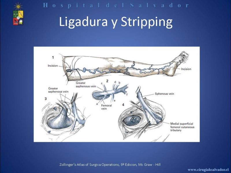 Diapositiva 13 de Safenectomía