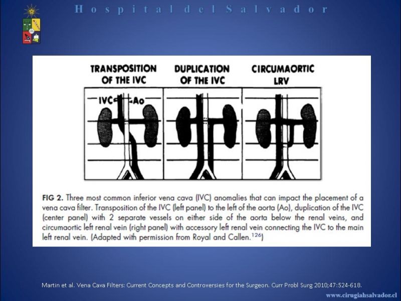 Diapositiva 15 de Filtro Vena Cava