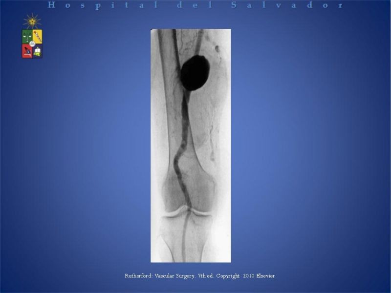 Diapositiva 16 de Aneurismas Arteriales EEII