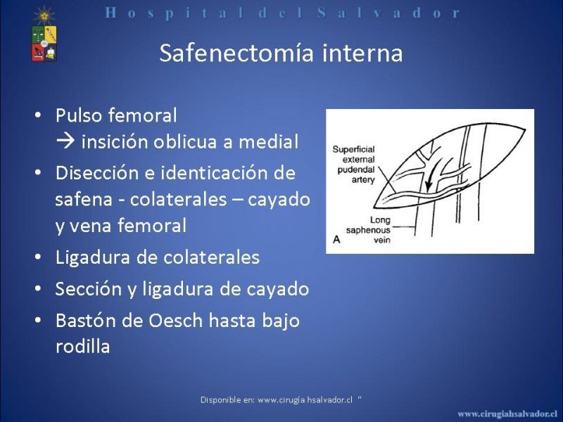 Diapositiva 12 de Safenectomía