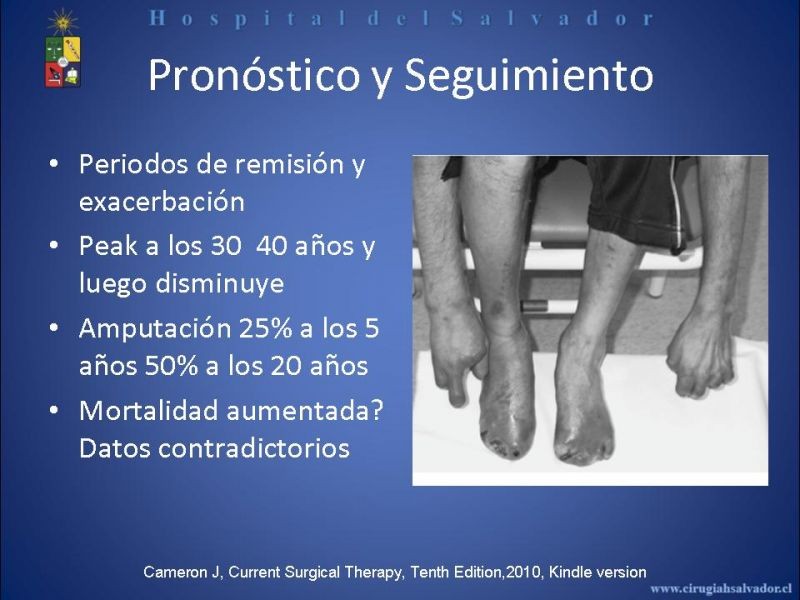 Diapositiva 29 de Tromboangeitis Obliterante(Enfermedad de Buerger)
