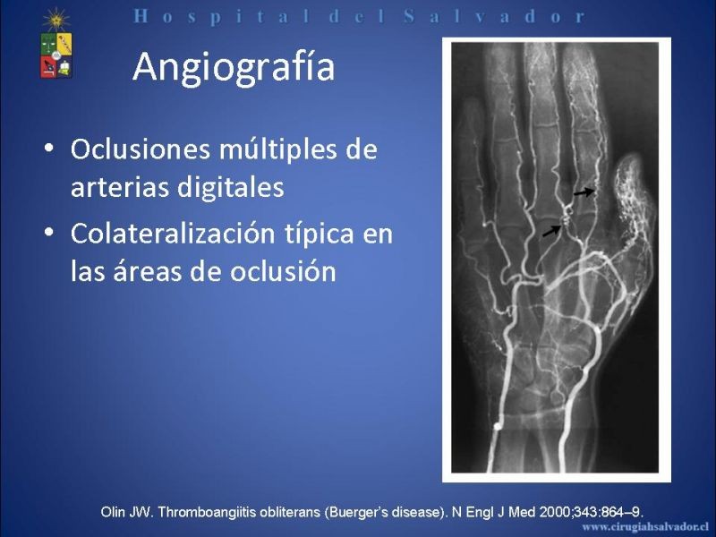 Diapositiva 19 de Tromboangeitis Obliterante(Enfermedad de Buerger)