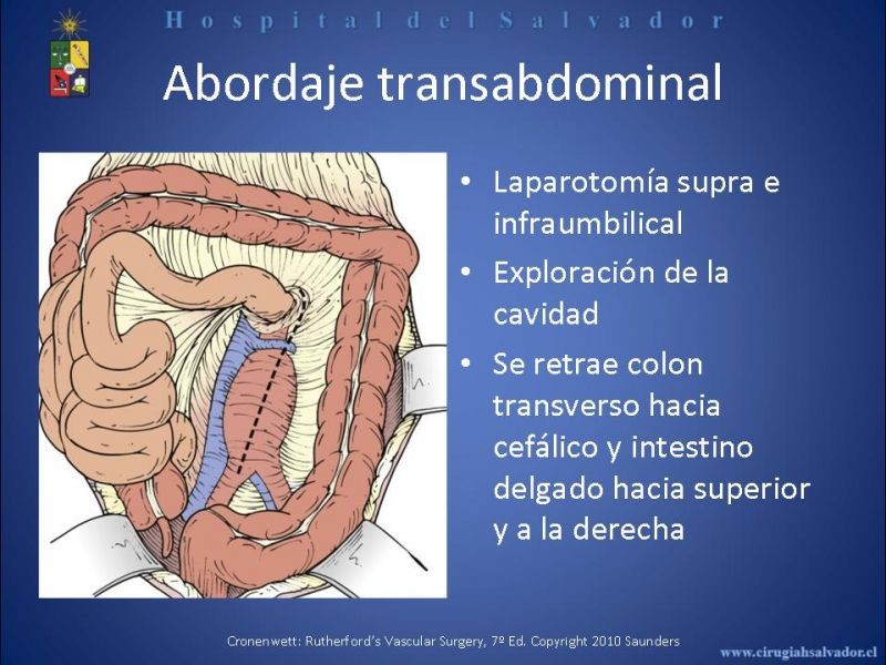 Diapositiva 11 de Abordaje de Aorta abdominal