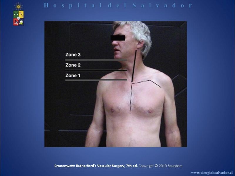 Diapositiva 29 de Trauma Vascular Cervical