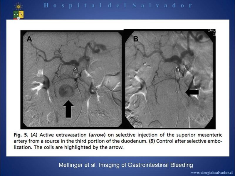 Diapositiva 15 de Angiografía en Hemorragia Digestiva