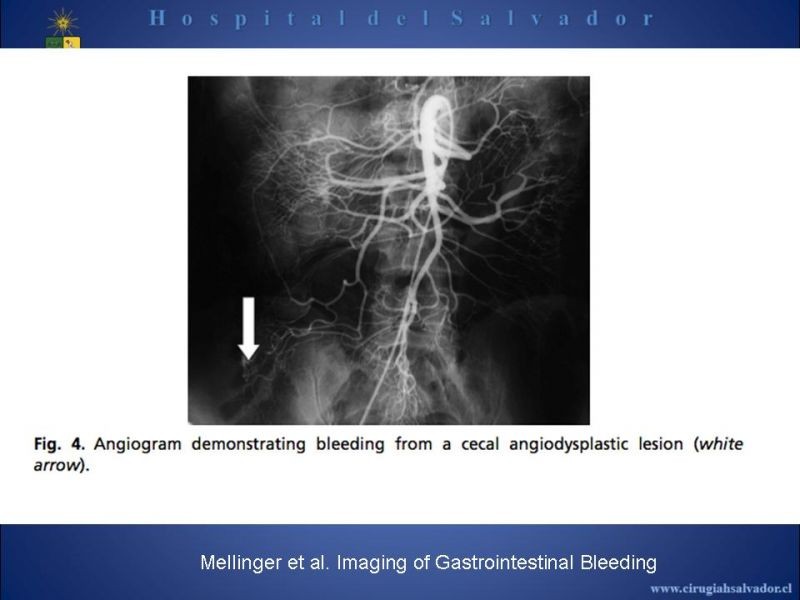 Diapositiva 8 de Angiografía en Hemorragia Digestiva
