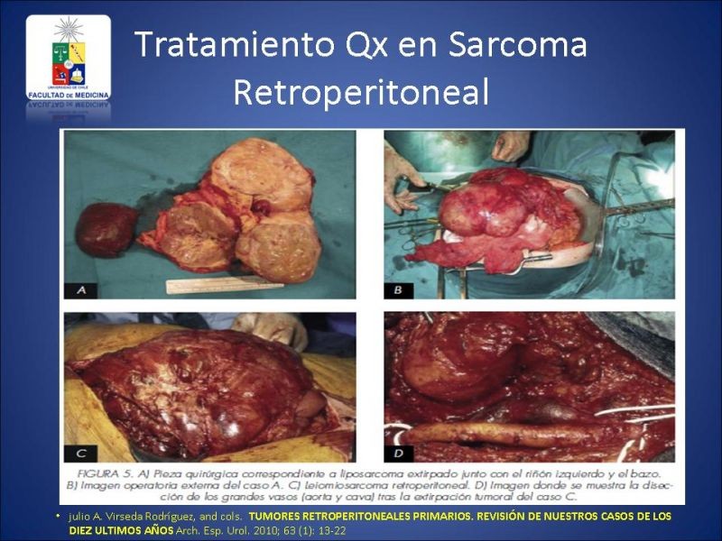 Diapositiva 21 de Sarcoma Retroperitoneal