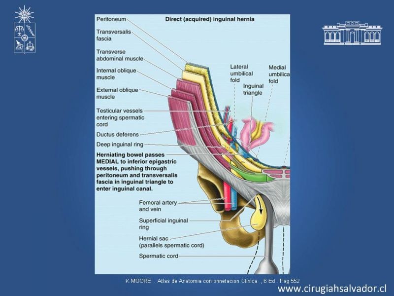 Diapositiva 3 de Laparoscopia en Hernia Inguinal