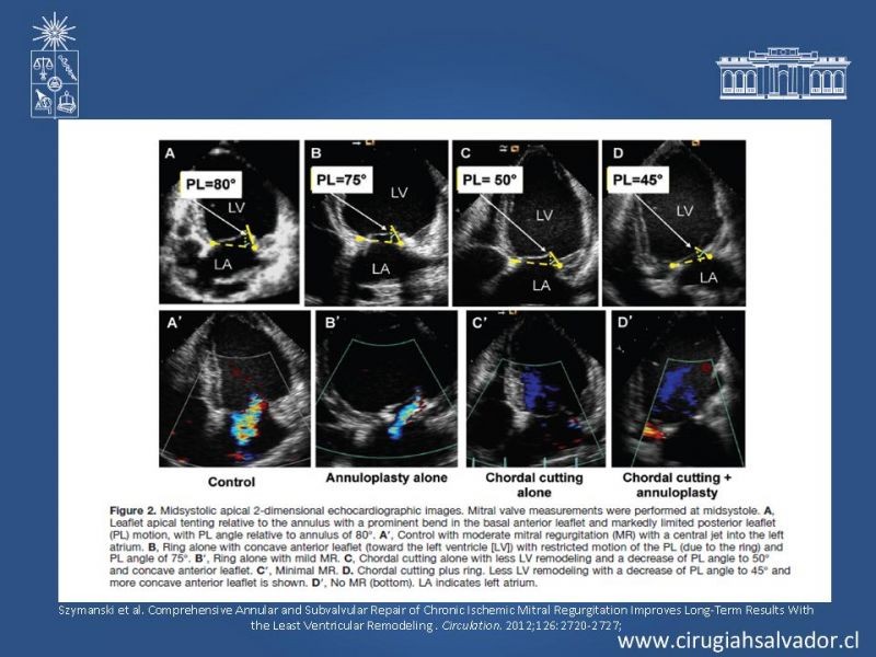 Diapositiva 25 de Insuficiencia Mitral Isquémica