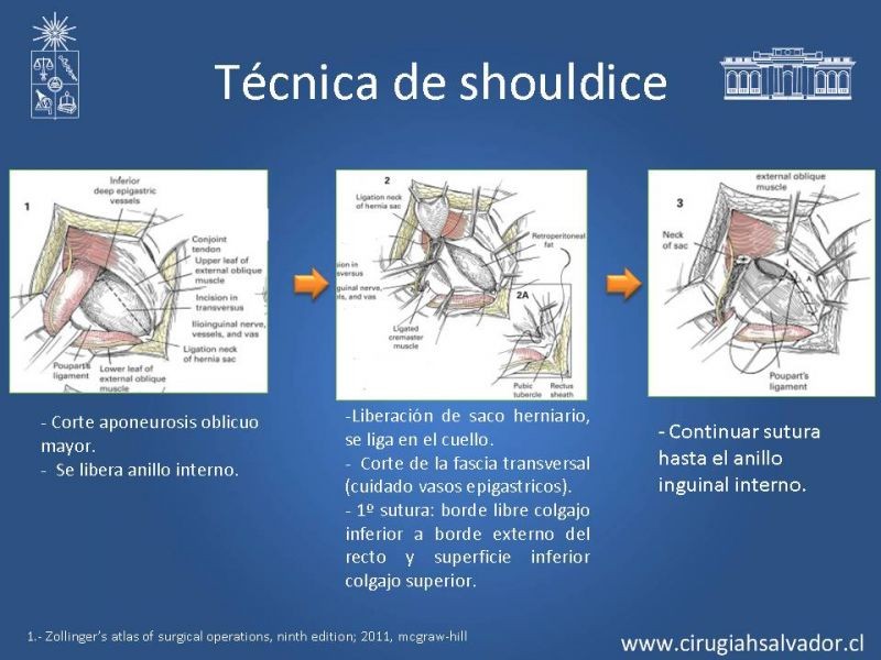 Diapositiva 7 de Hernia inguinal