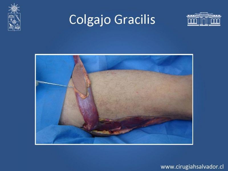 Diapositiva 26 de Transfusiones en Cirugía Mayor Abdominal pt. 2