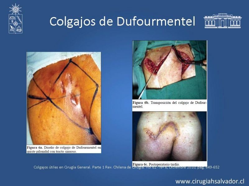 Diapositiva 12 de Colgajos útiles en cirugía general
