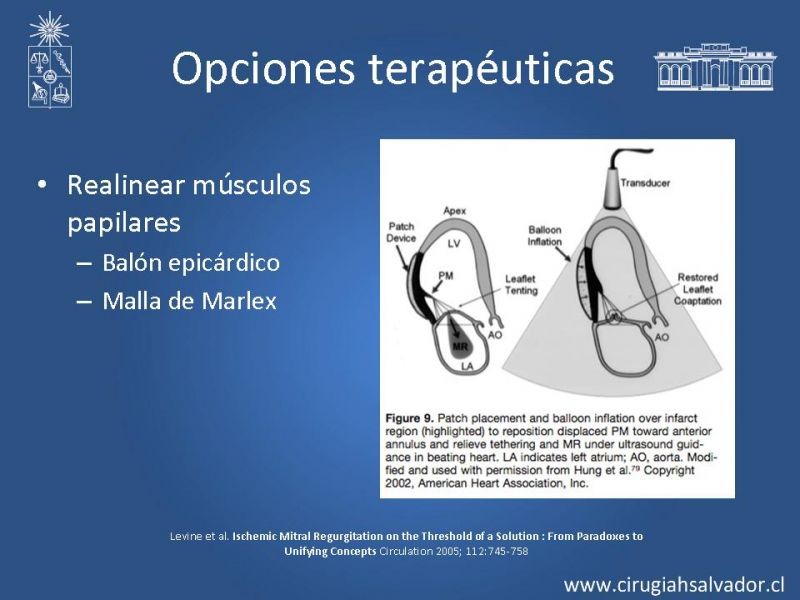 Diapositiva 13 de Insuficiencia Mitral Isquémica