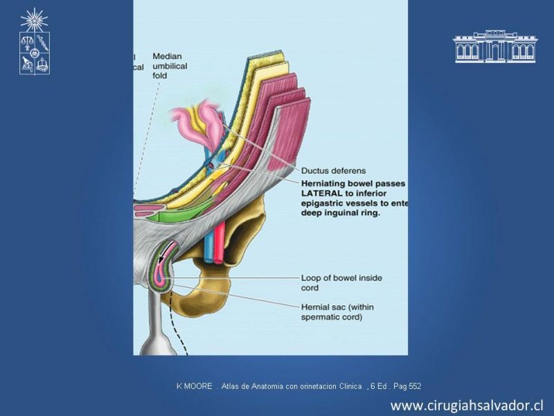 Diapositiva 4 de Laparoscopia en Hernia Inguinal