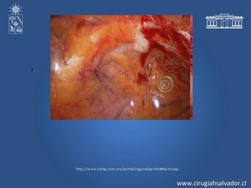Diapositiva 19 de Laparoscopia en Hernia Inguinal