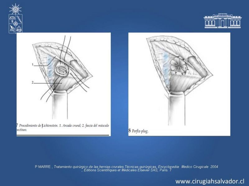 Diapositiva 16 de Hernia Crural 2