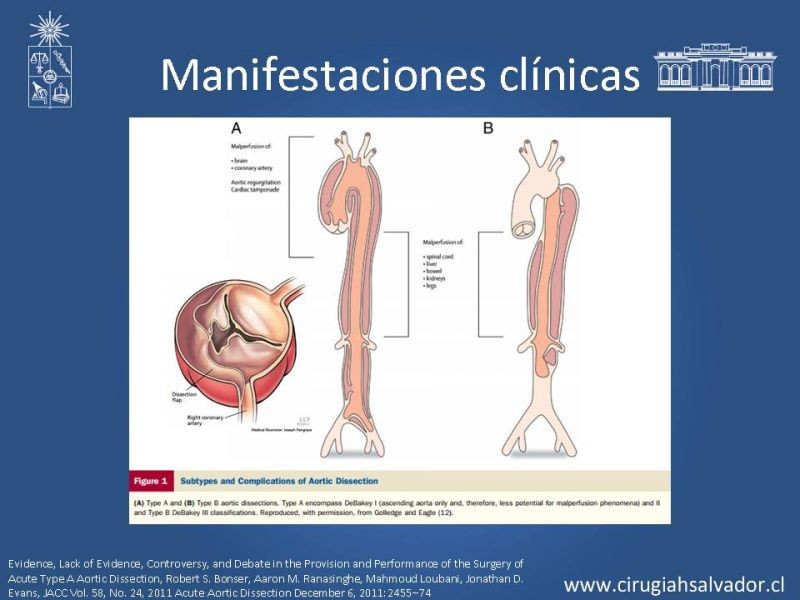 Diapositiva 7 de Disección aórtica tipo A