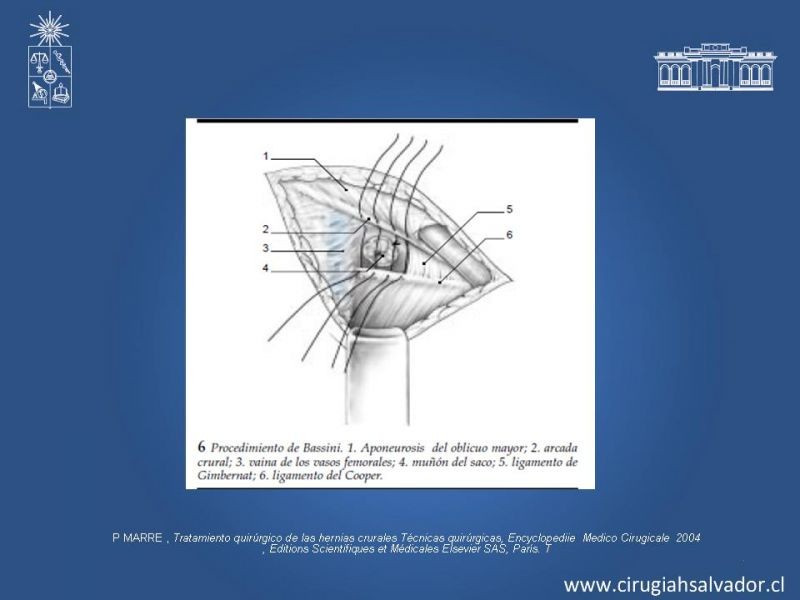 Diapositiva 16 de Hernia Crural 1
