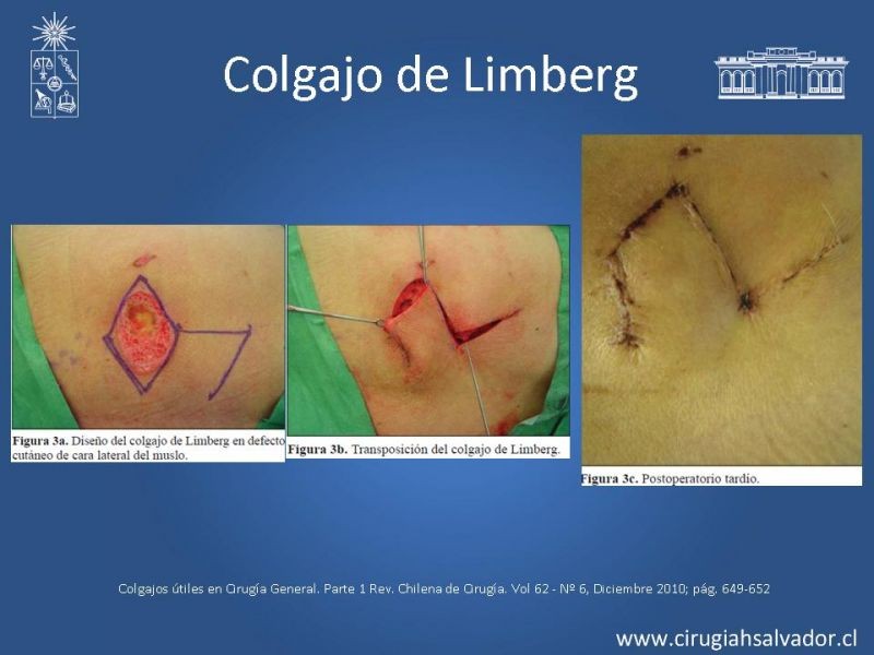 Diapositiva 10 de Colgajos útiles en cirugía general