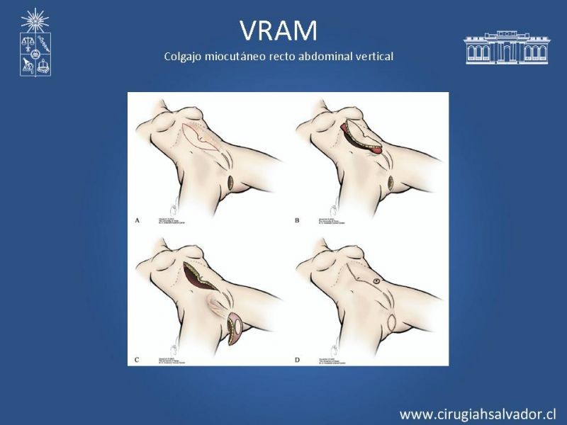 Diapositiva 12 de Transfusiones en Cirugía Mayor Abdominal pt. 2