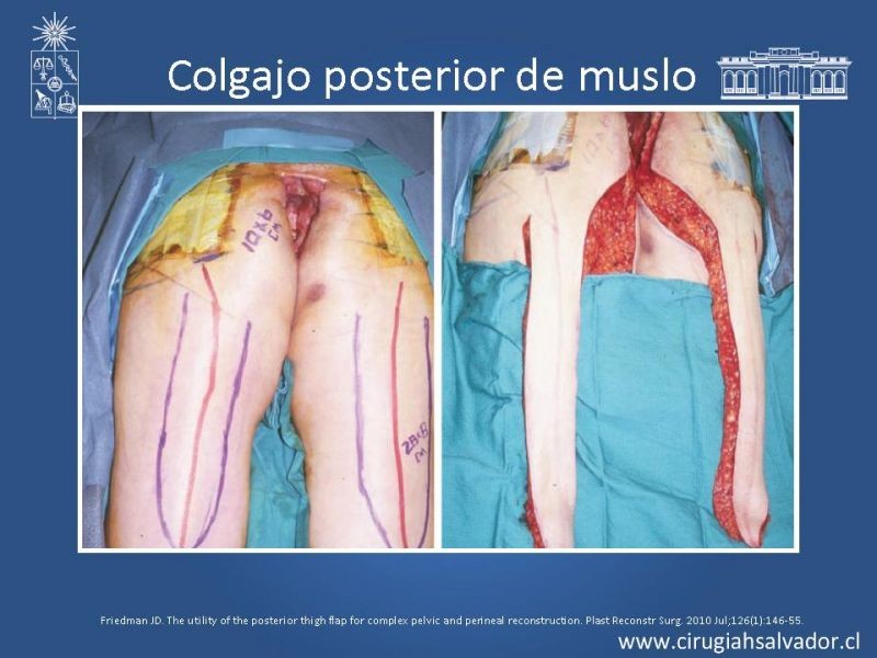Diapositiva 35 de Transfusiones en Cirugía Mayor Abdominal pt. 2