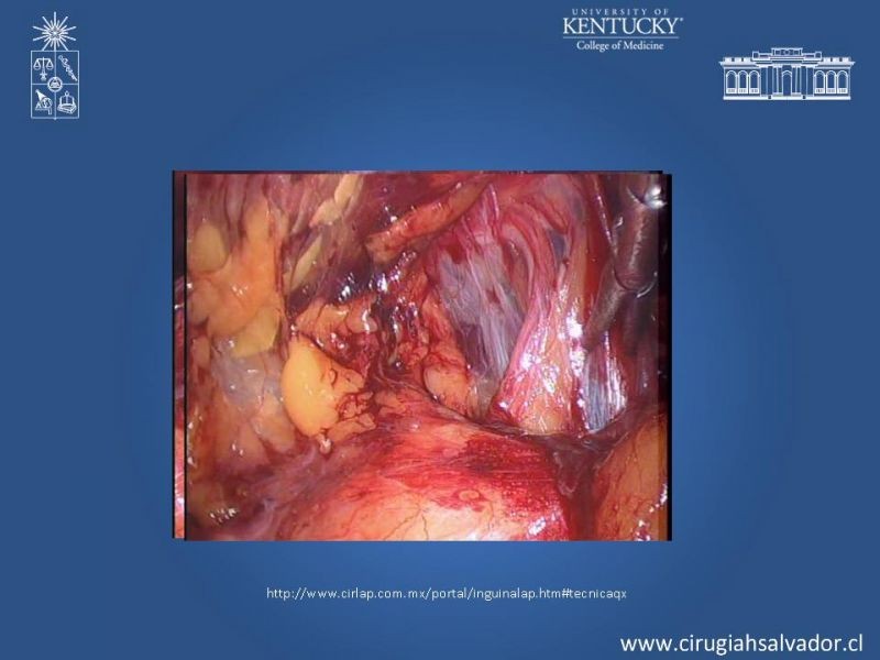 Diapositiva 20 de Laparoscopia en Hernia Inguinal
