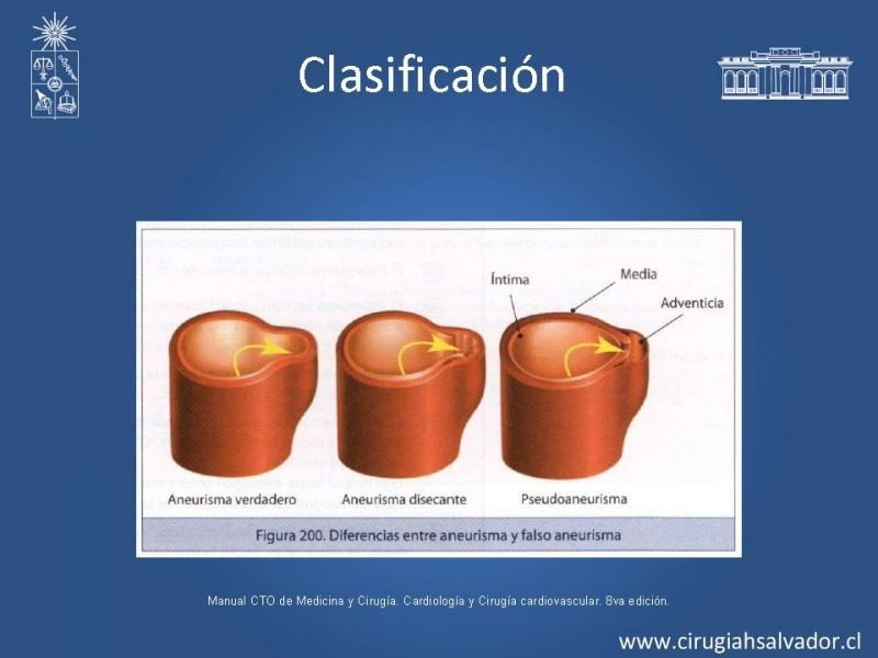 Diapositiva 6 de Reparación endovascular de aneurismas de aorta torácica (TEVAR)