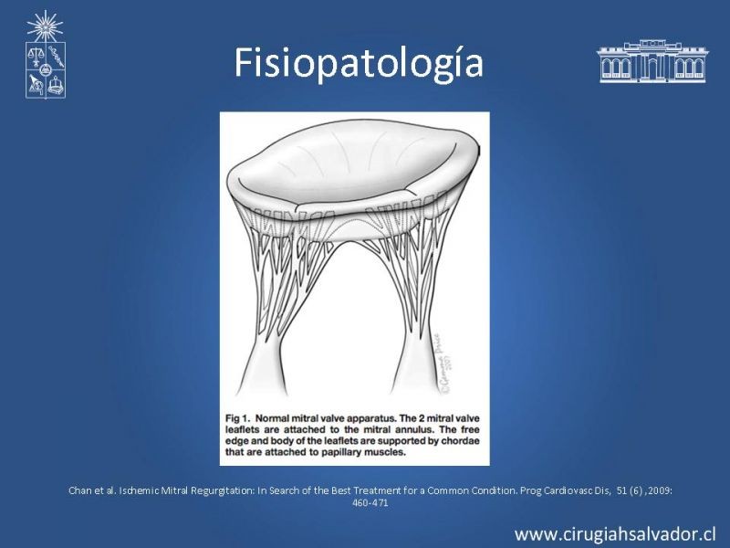 Diapositiva 7 de Insuficiencia Mitral Isquémica