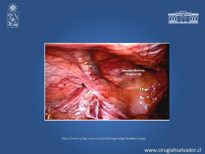 Diapositiva 9 de Laparoscopia en Hernia Inguinal