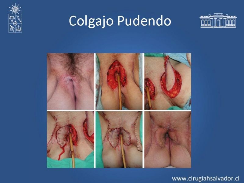 Diapositiva 31 de Transfusiones en Cirugía Mayor Abdominal pt. 2