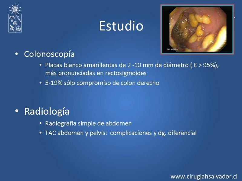 Diapositiva 15 de Sindrome diarreico por Clostridium Difficille