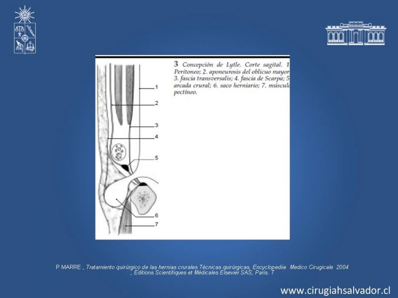 Diapositiva 13 de Hernia Crural 1
