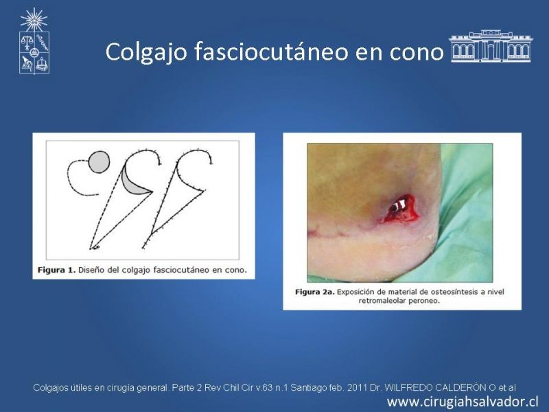 Diapositiva 13 de Colgajos útiles en cirugía general