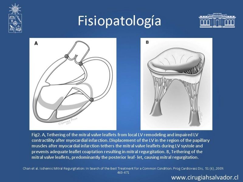 Diapositiva 8 de Insuficiencia Mitral Isquémica