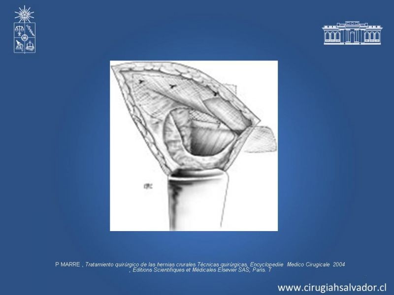 Diapositiva 20 de Hernia Crural 1