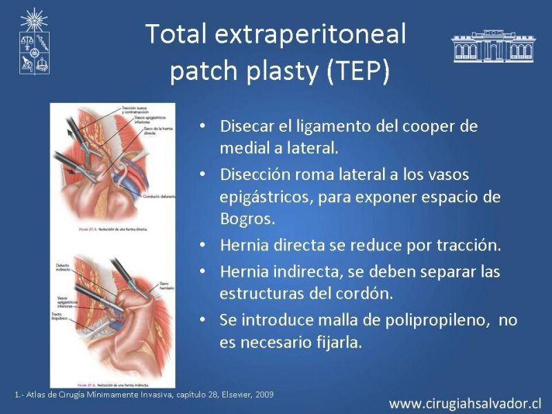 Diapositiva 17 de Hernia inguinal