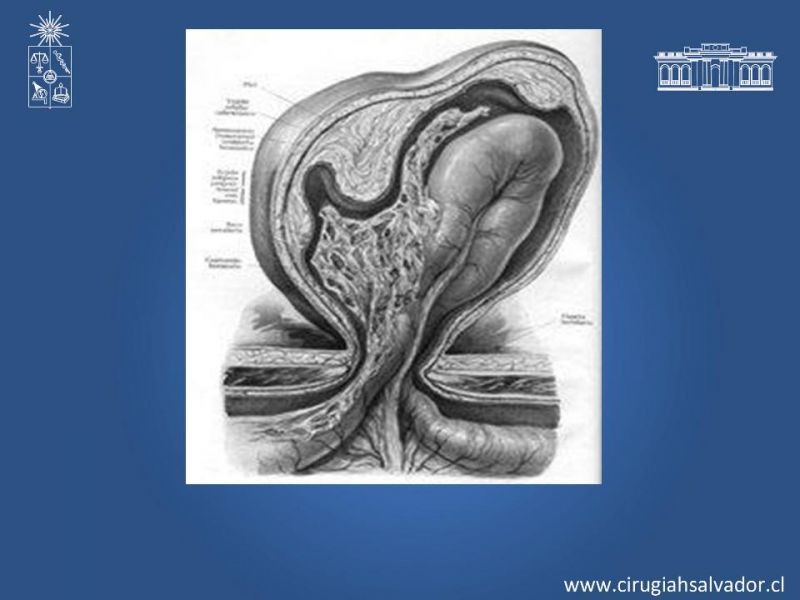 Diapositiva 2 de Hernia Crural 1