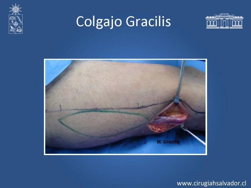 Diapositiva 21 de Transfusiones en Cirugía Mayor Abdominal pt. 2