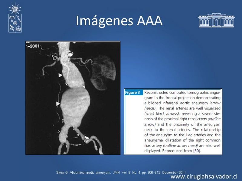 Diapositiva 18 de Aneurisma de Aorta Abdominal:Generalidades