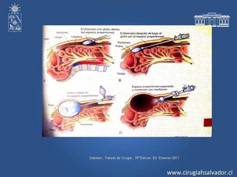 Diapositiva 15 de Laparoscopia en Hernia Inguinal